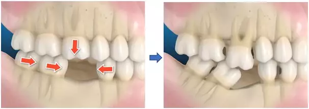 Gigi tanggal perlukah di ganti dan apa dampaknya bila tidak diganti?