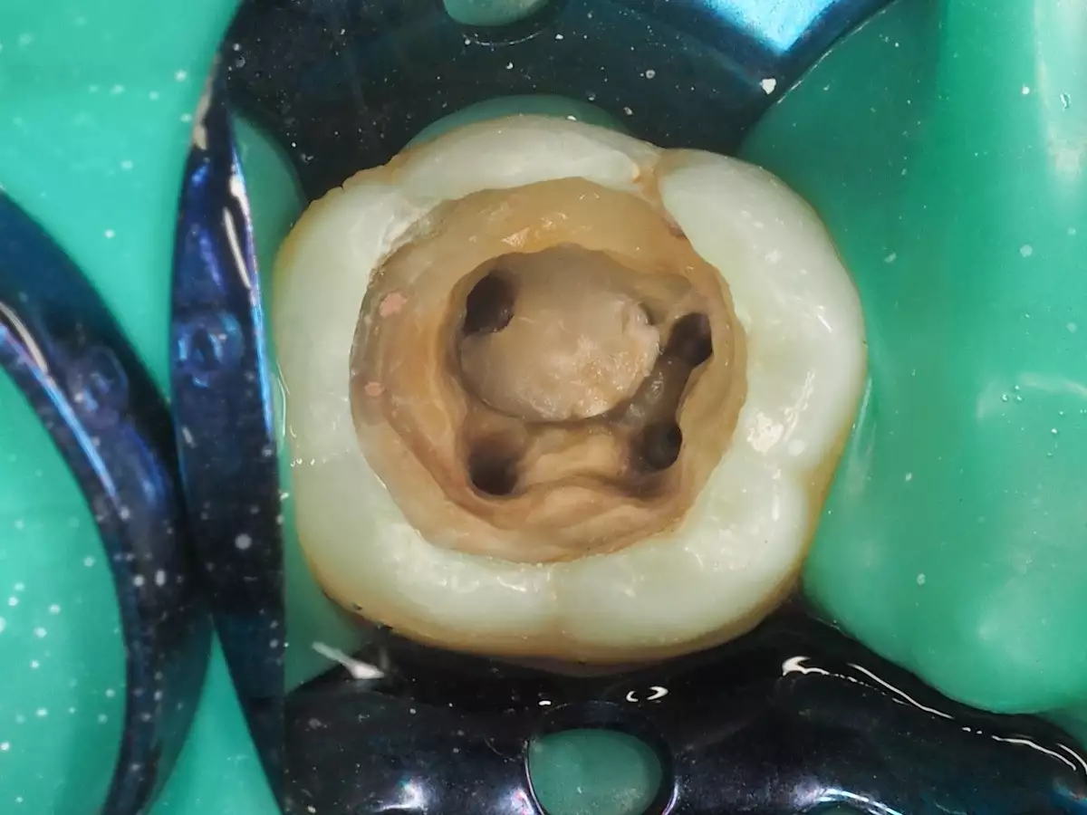 PERAWATAN SALURAN AKAR GIGI ( ENDODONTIC TREATMENT)