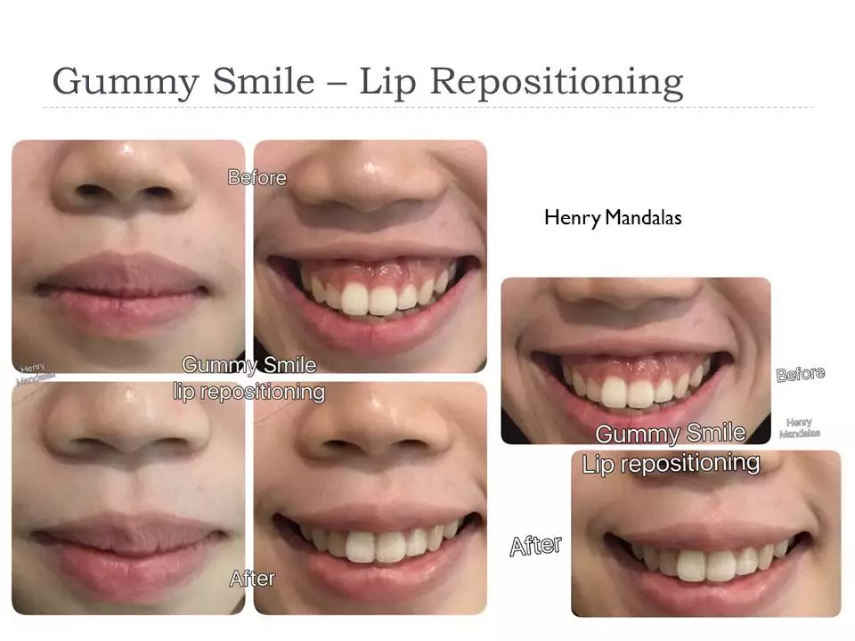 GUMMY SMILE bikin ga PEDE? 