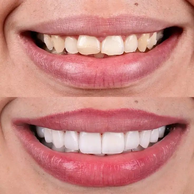 VENEER GIGI